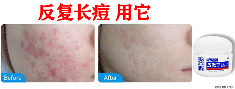 宫本武藏祛痘膏去痘痘面霜修复痘印痘坑淡化青春痘男女学生闭口粉刺10g