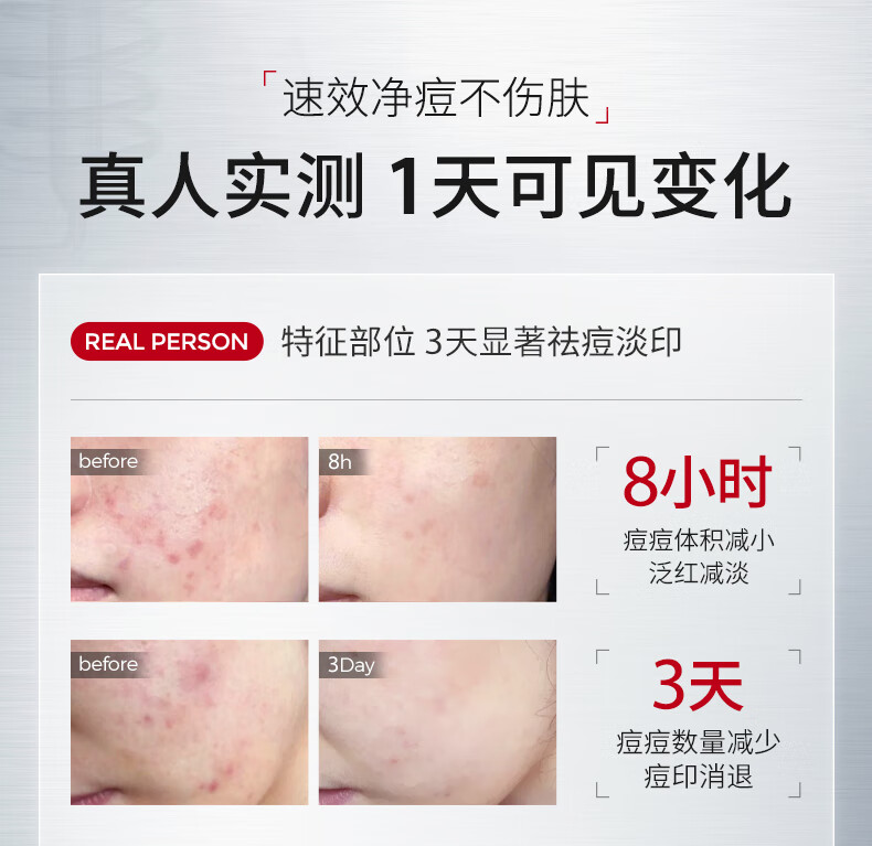 ning新加坡进口祛痘凝露淡化痘印修护痘痘红肿痘疤痘坑收缩毛孔芦荟胶
