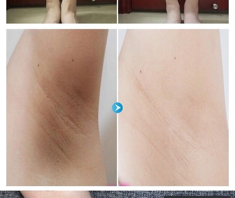 NHFOUYOU【不黑不买】美白全身关节膝盖手指手肘脖子美白祛斑霜淡化色素 1盒【建议按疗程】