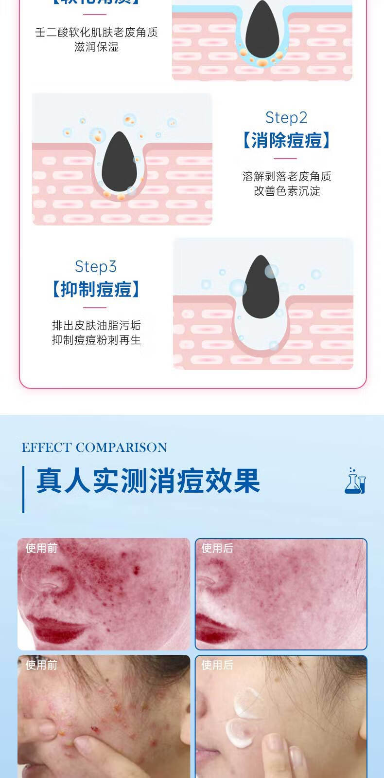 珂卡薇壬二酸15%凝胶水杨酸细致毛孔霜修颜凝露淡痘印黑头闭口粉刺30ml