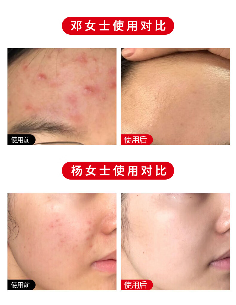 RYDEEN 壬二酸祛痘膏水杨酸净痘膏平衡痘肌痘坑熬夜助手学生党平价 三支装