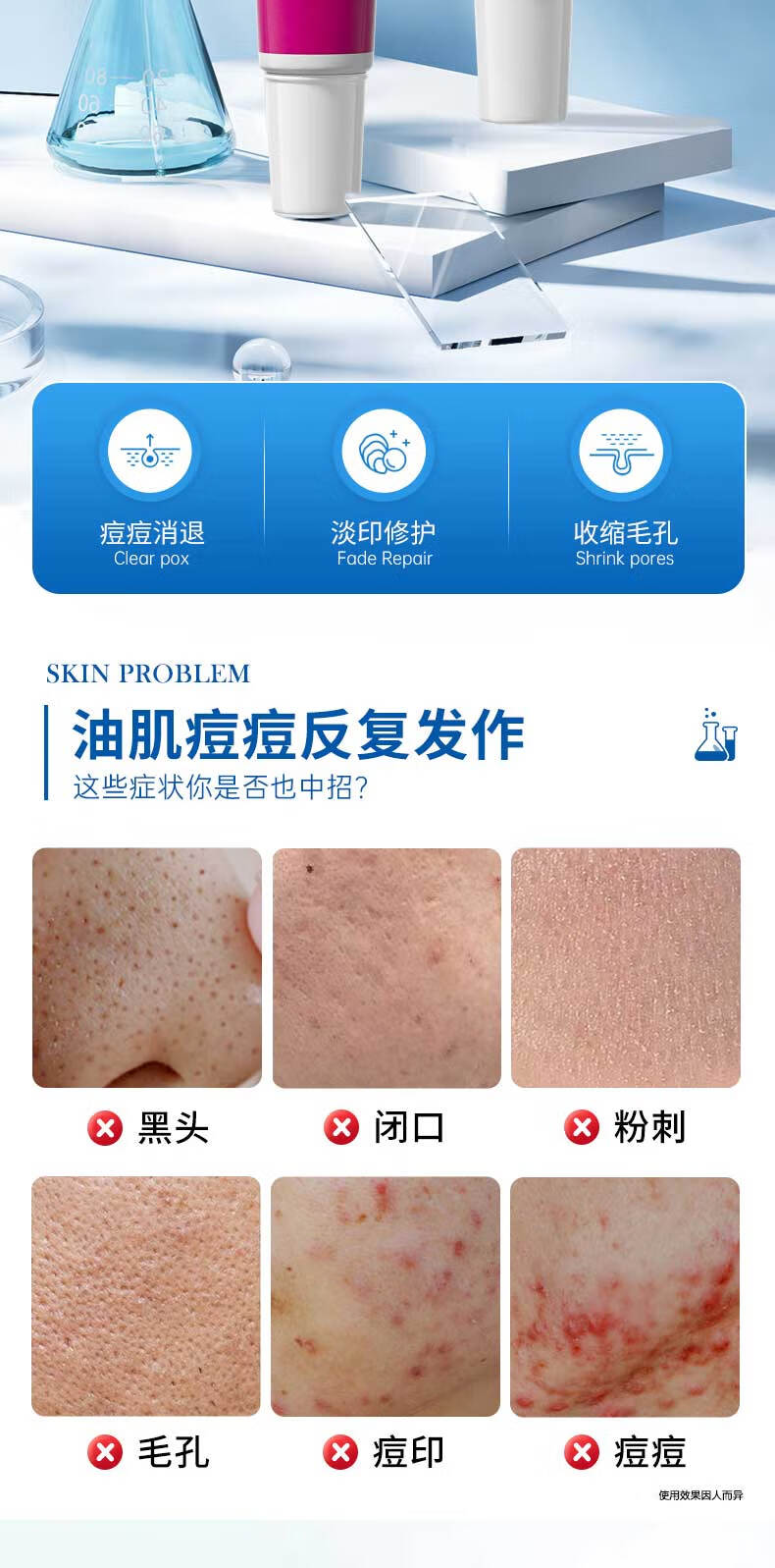 珂卡薇壬二酸15%凝胶水杨酸细致毛孔霜修颜凝露淡痘印黑头闭口粉刺30ml
