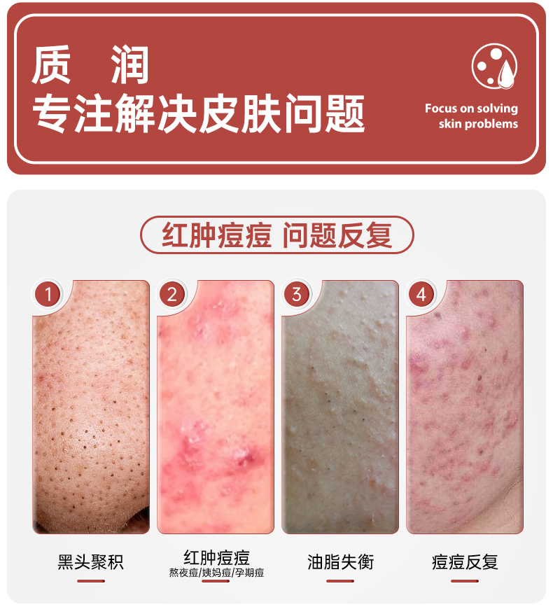 质润壬二酸20%凝胶15g*2祛痘膏去黑头闭口粉刺20%壬任二酸祛痘凝胶