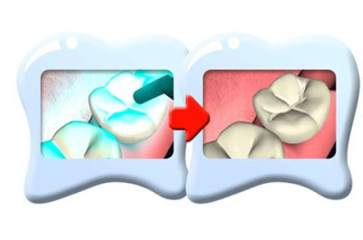 48元彤名韩国窝沟封闭套 - 大庆团购网|京东团