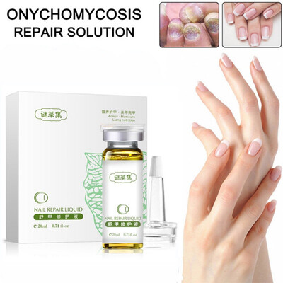 

Kills 999 Bacteria Nail Care Treatment Nail Fungus Oil Onychomycosis Paronychia Anti Fungal Nail Infection 20ml Repair Nails