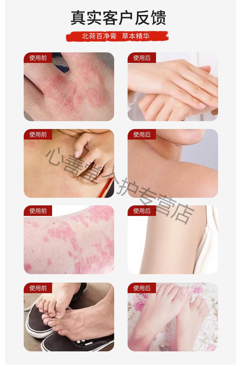 北荷百净膏植物草本乳膏成人儿童用涂膏皮肤瘙痒干燥脱屑荨蔴痒股鲜花