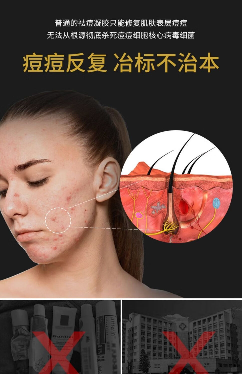 姗拉娜祛痘膏祛痘棒淡化痘印凝胶去痘疤痘坑修复粉刺闭口男女雅慕诗婷