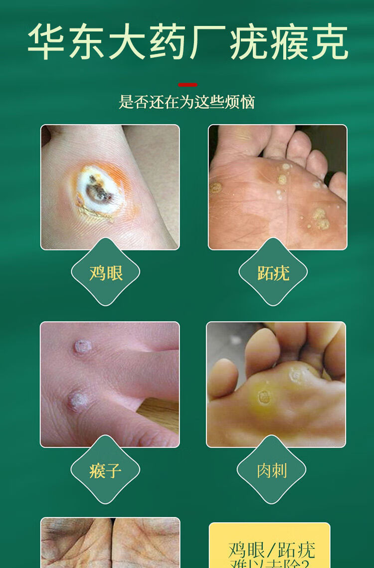 日本进口疣瘊克丘平疣去脖子腋下丝l状疣肉粒皮赘瘊丁坨疣进口疣瘊