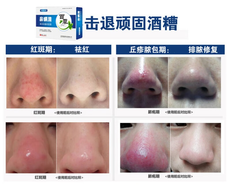 官方誉芙美鼻螨清酒糟鼻红酒糟鼻专用酒糟鼻修复红鼻子红液红鼻头软膏