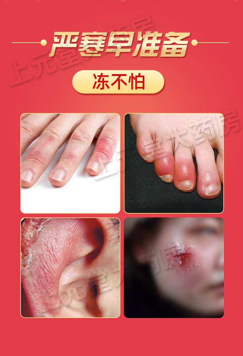 冰王鳄油冻疮膏消乳膏30g冻手冻脚膏成人儿童耳朵可搭冻裂冻伤膏手足