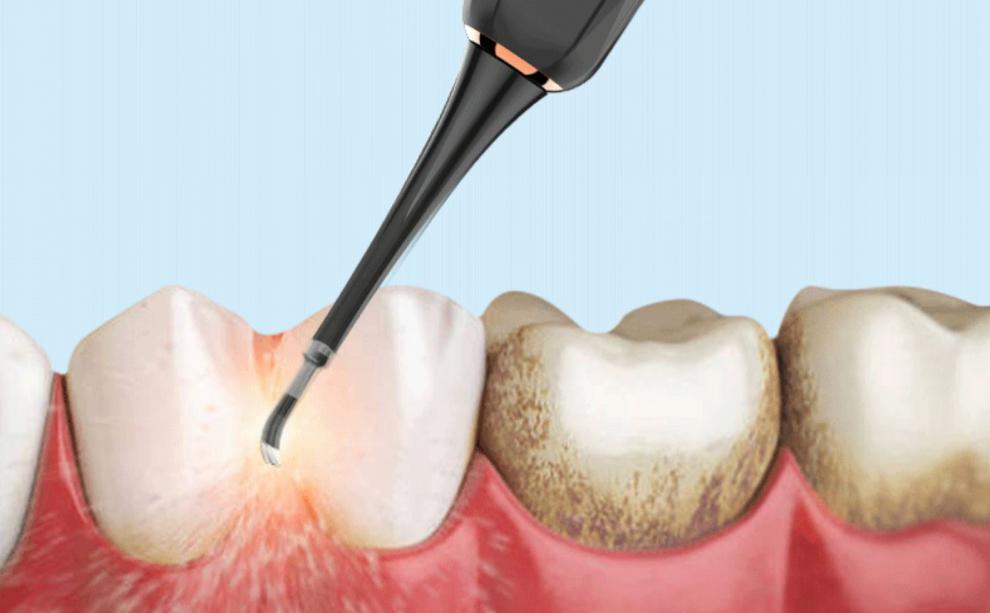 【京选好货】德国lm超声波洁牙器家用牙垢牙结石去除器电动洗牙器牙齿