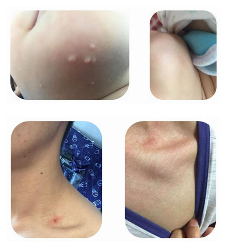 扁平尤尖锐湿疣丝状尤寻常尤疣肉粒刺猴子搭咪喹1莫特乳膏氟脲尿嘧瘊