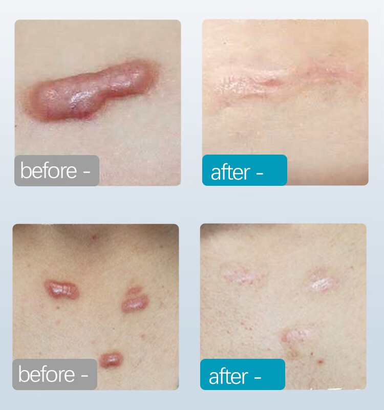 疤痕灵修复膏疙瘩去除增生软化凸起伤疤瘢祛淡化黑色素沉淀一抹消 1瓶