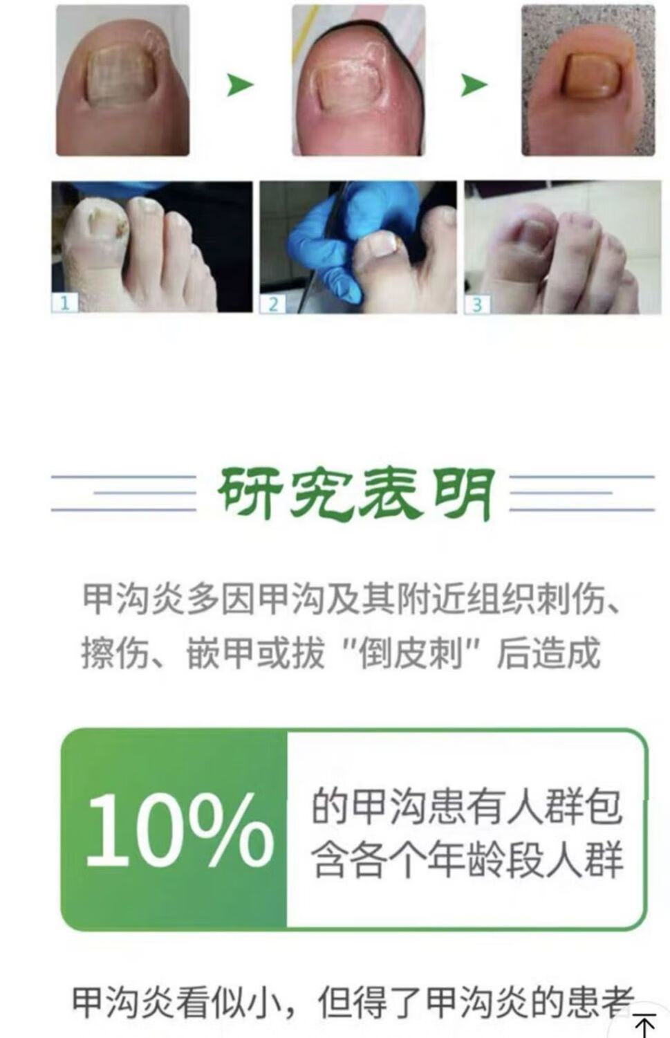恩宝佳必力欣甲立舒滋芙宝甲沟肉芽甲利舒甲力舒保证 甲立舒*1盒