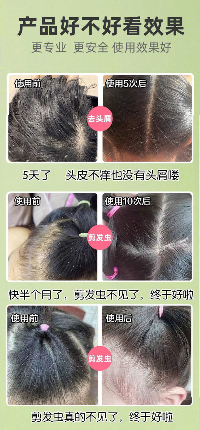315岁中大童儿童除螨洗发水剪发虫头皮痒去屑除螨虫止痒洗发露1瓶洗发