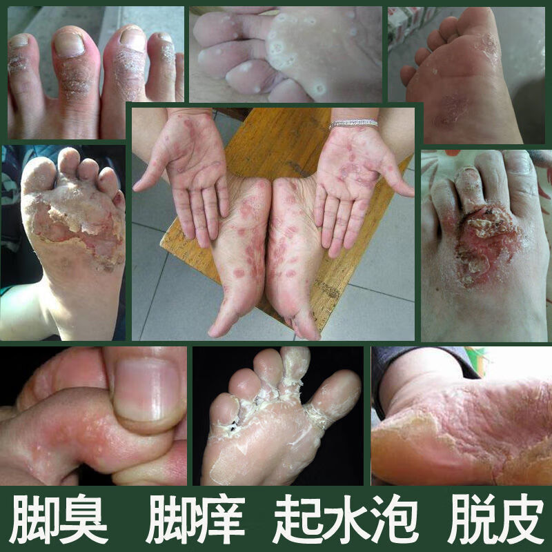 脚气王烂脚丫脚痒水泡脱皮糜烂脚气膏脚气去脚臭脚汗喷剂喷雾 知足侠