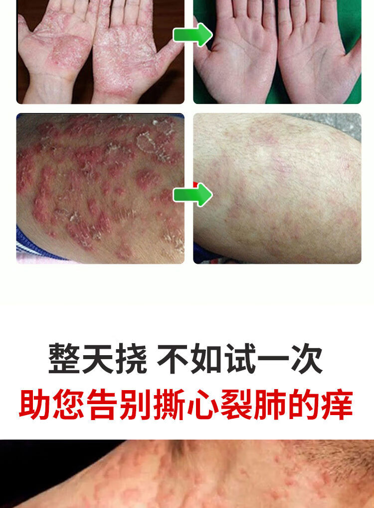 止痒膏云南青草膏成人儿童快速止痒膏过敏身上痒皮ii炎湿ii疹荨麻ii疹