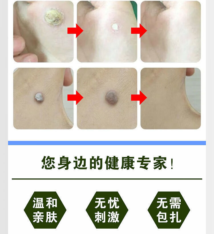 5氟尿嘧啶祛l疣瘊l子治l疗扁平l疣一抹灵寻常丝状l疣去除神器颈部专用