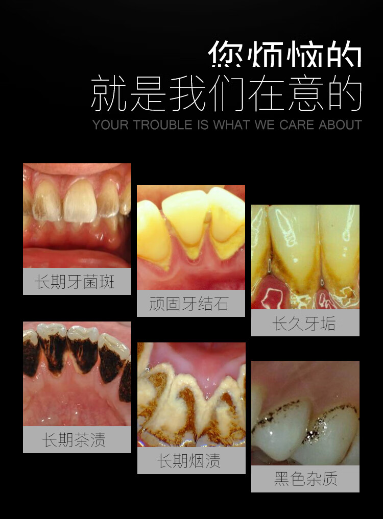 牙镜牙结石去除器牙齿清洁工具洗牙牙石清除剔牙神器牙垢牙镜子口腔镜