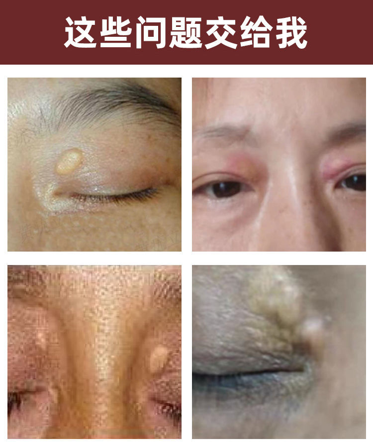 【无痛去睑黄瘤】去除睑黄疣脸黄瘤眼部眼睑黄瘤脂肪粒草本睑黄膏 单