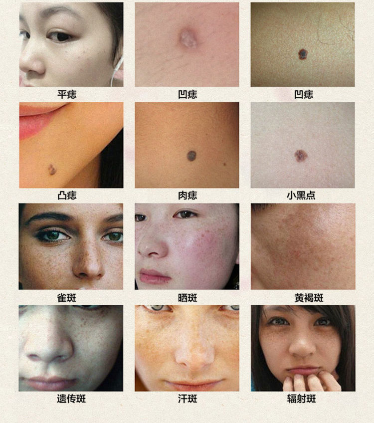 去痣点痣药水无痕黑痣祛痣斑水祛痣膏修复防疤笔脸部雀斑 【1套】诗