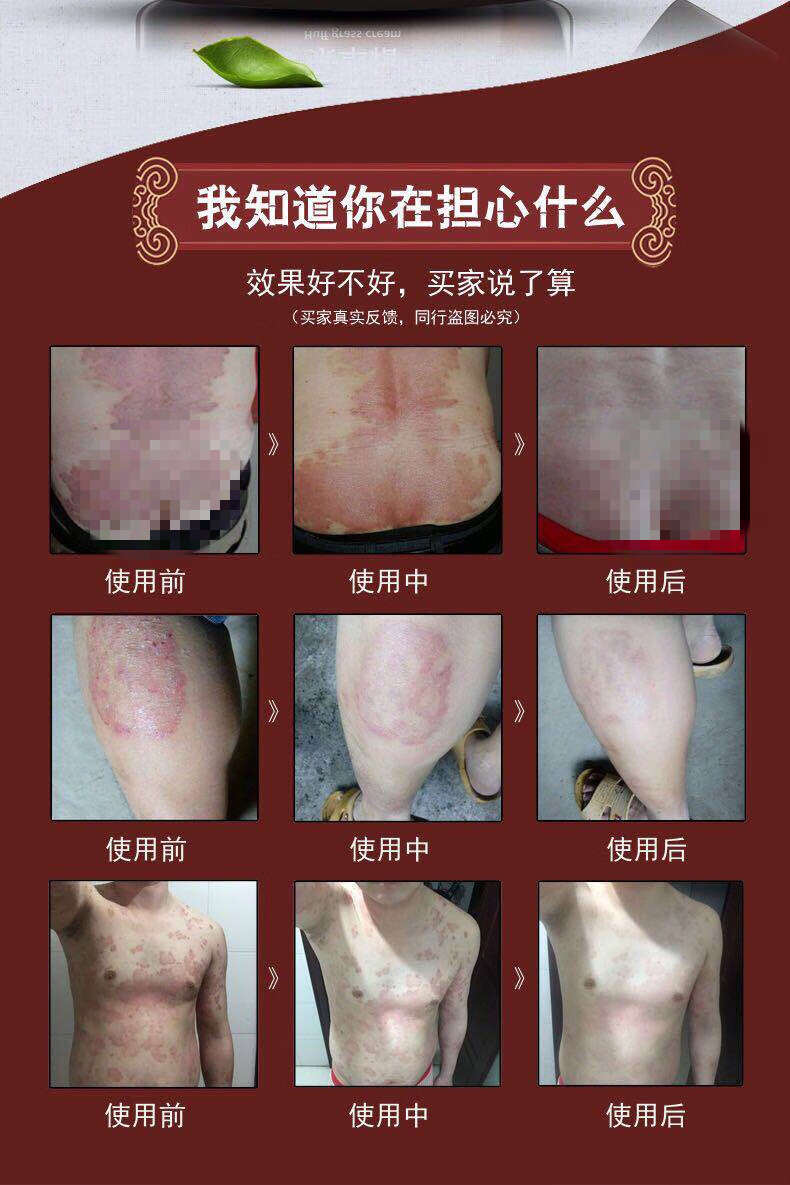 紫椒廯酊净牛皮头去瘙皮肤瘙痒止痒全身适用外用 :【图片 价格 品牌