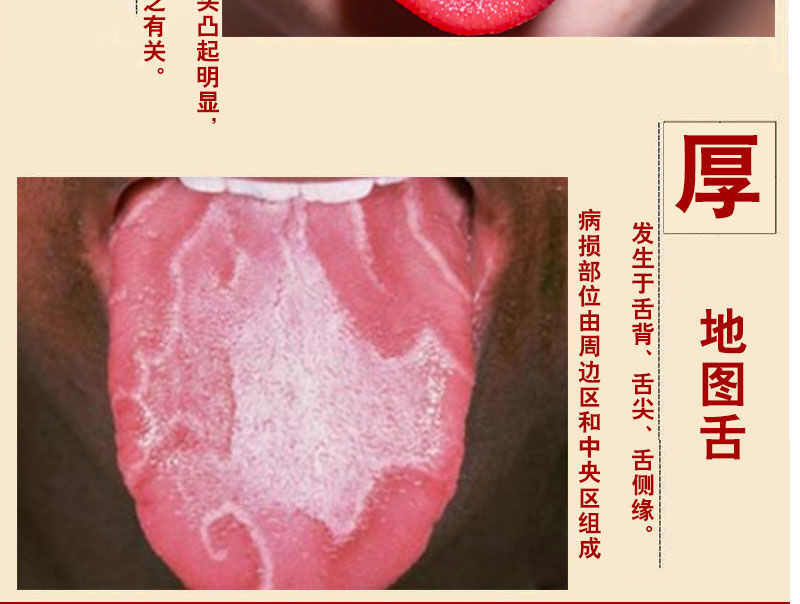 dj好物48种顽固苔癣起泡烂嘴疮扁平裂纹舌舌炎地图舌烂舌头黑舌痛肿胀