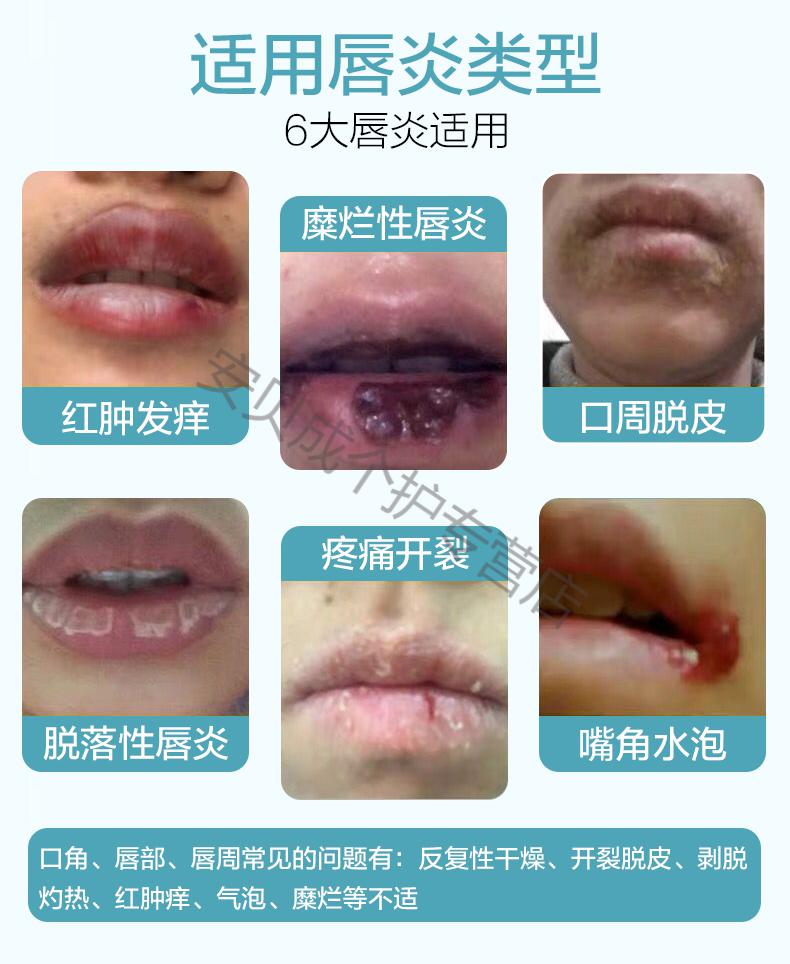 官方专营唇愈康修复口唇焱嘴唇干裂脱皮起火泡嘴角开裂烂嘴角防干裂