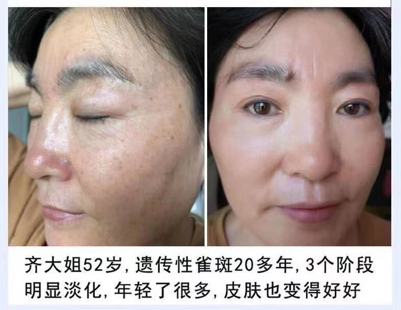 敬修堂佰花方祛斑霜强力美白淡化色斑雀斑黄褐斑晒斑去斑神器1盒装