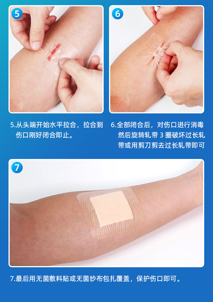 减张器拉链式创口贴医用皮肤疤痕减张贴儿童成人张力贴刨腹产术后减