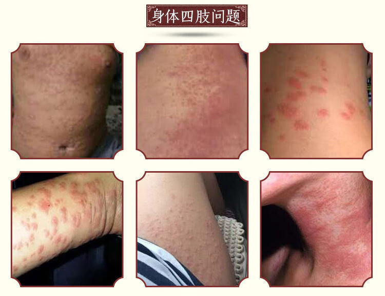 紫椒癣町酊牛皮l癣银l屑病头皮l癣手紫椒癣町酊牛头虎毒共发5盒巩固
