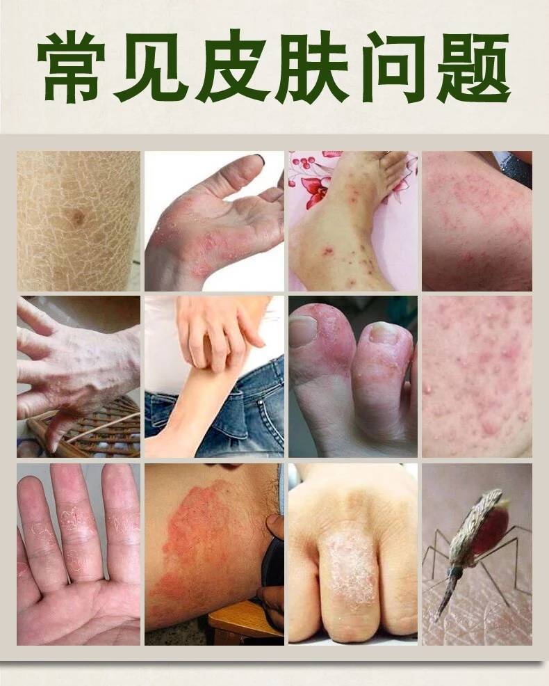 湿毒清苗药膏止痒皮炎湿疹膏皮肤瘙痒私处药皮康王牛皮癣百草霜王 3支