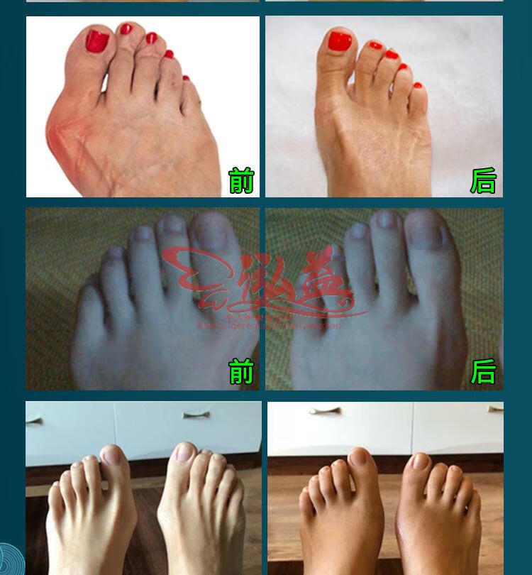 拇外翻【连裉拔】大拇指外翻脚趾重叠大脚骨矫正防磨脚专用 1盒体验装