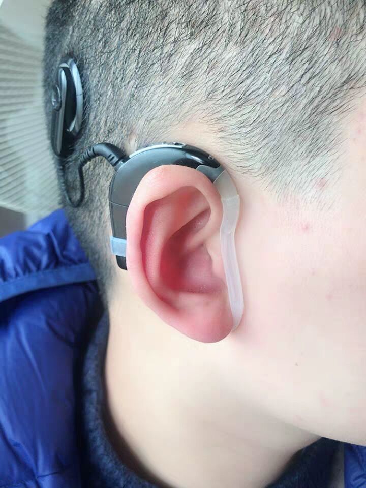 人工耳蜗,各种型号新版专利耳蜗可开发票 澳大n5,n6,n7【图片 价格