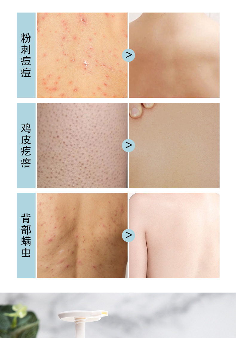 去背上长痘痘身上背后长痘痘粉刺除螨虫苦参净肤美肌除螨沐浴露清爽