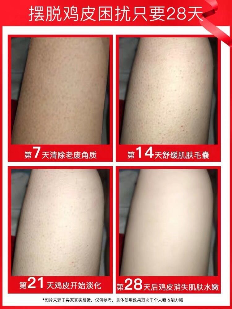 去鸡皮肤蛇皮肤严重(鸡皮肤蛇皮肤怎么消除)