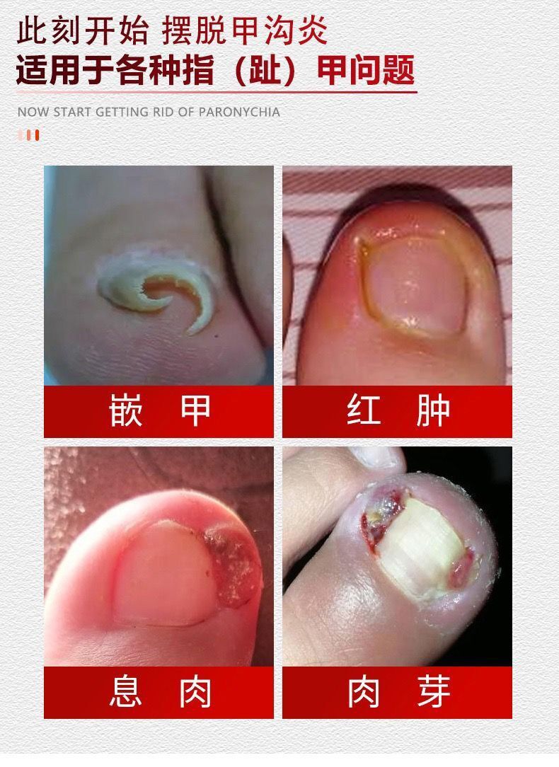 明泰3号三号治疗甲沟炎专用软化甲去肉芽消肿医生推荐款1盒装