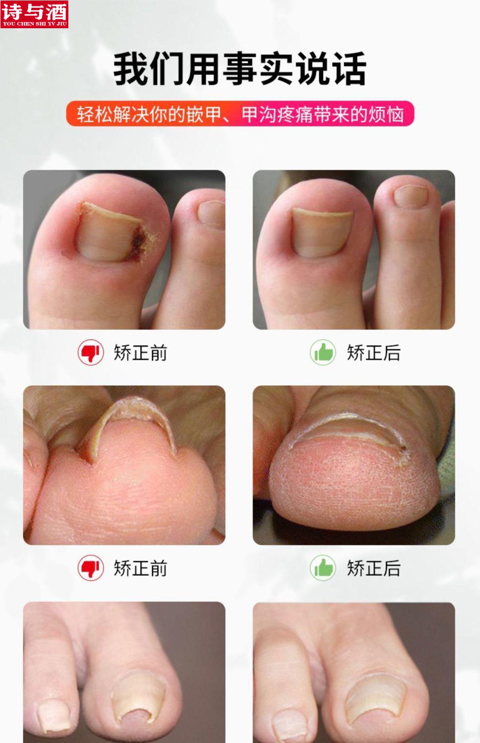 甲沟炎矫i正器 甲沟炎神器 正甲扣正甲嵌甲贴甲沟脚趾甲卷甲钳修脚炎s