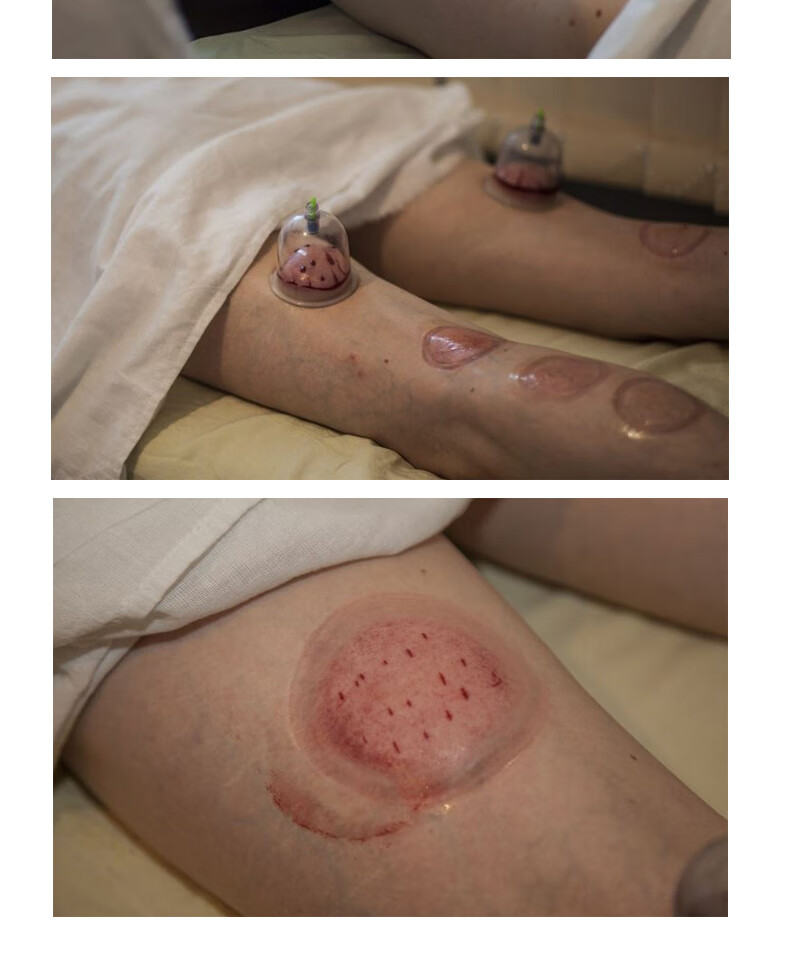 素界器械店采血笔点刺血针拔罐刺络医用家用血糖仪的一次性排瘀放血泻