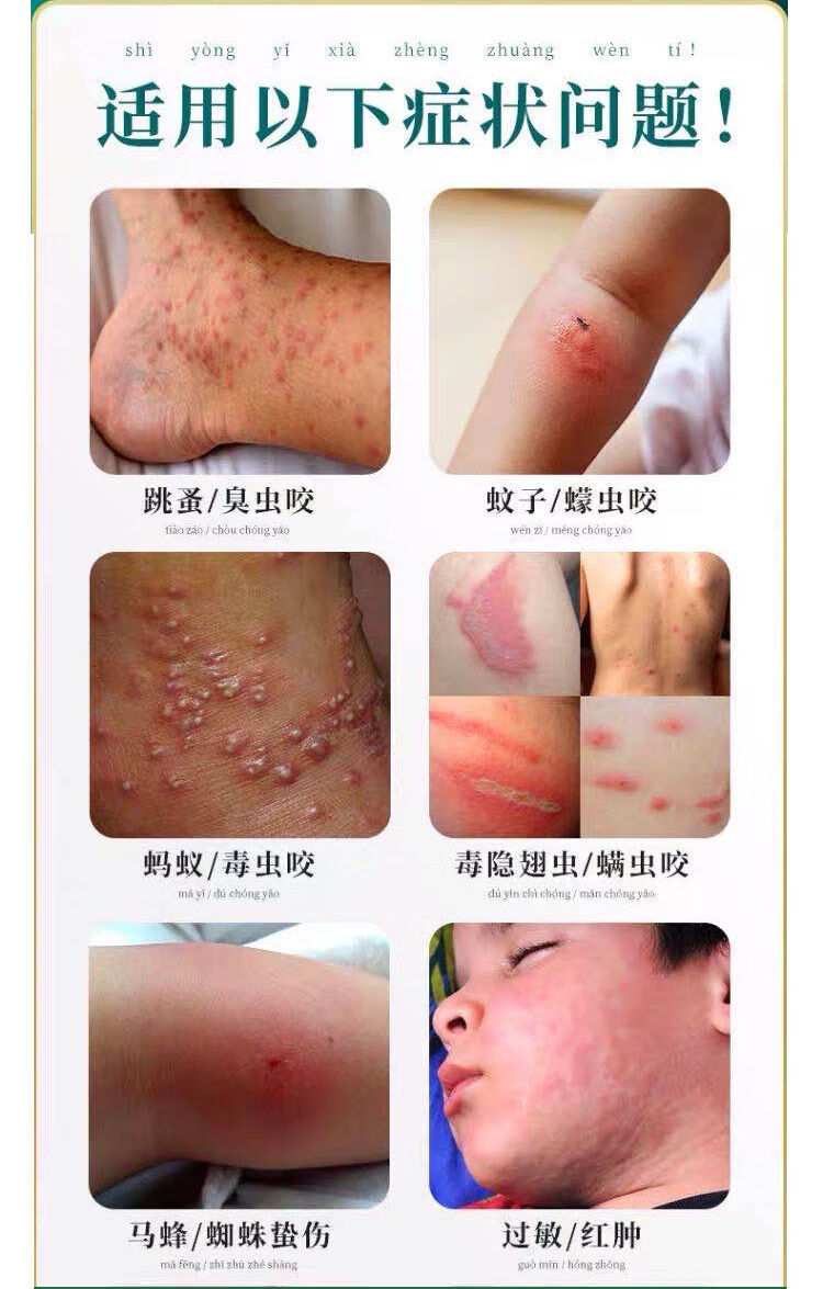 驱i蚊膏被毒虫红蚂蚁咬伤螨虫跳蚤蚊虫叮咬止痒皮肤瘙痒过敏消包紫草
