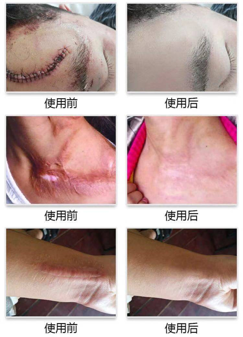 嘉古膏淡ll化ll黑ll色ll素剖腹产烫伤脸部增生凹凸
