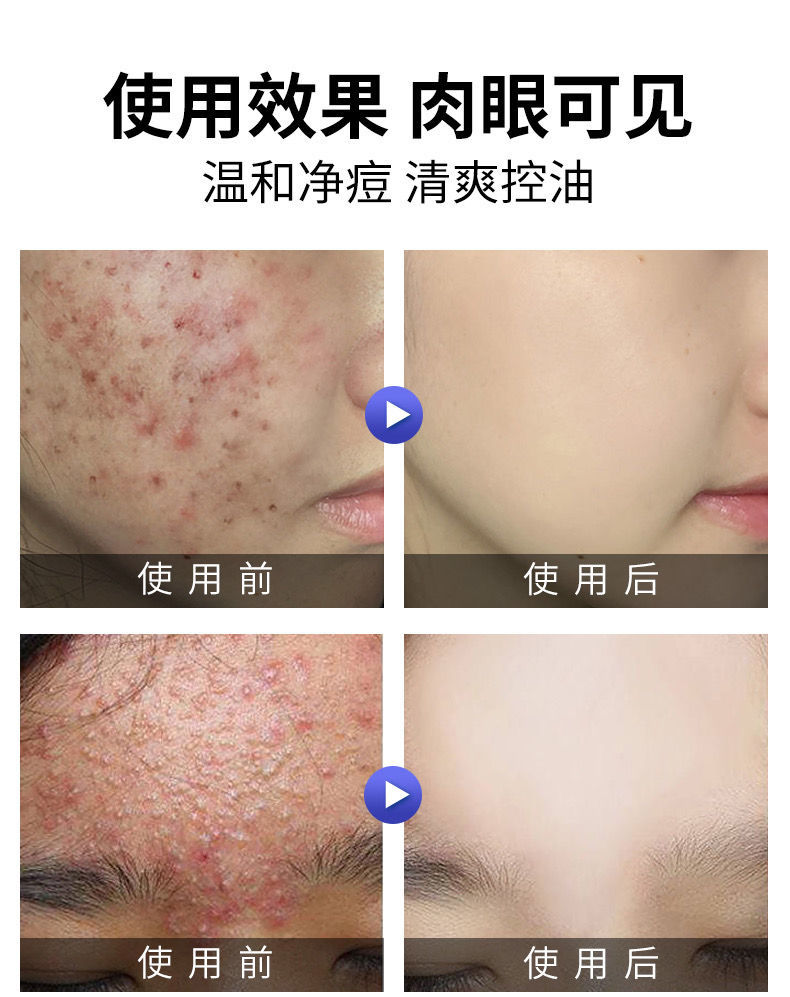 华南理工大学研发洗面奶韩鹭洗面奶水杨酸控油去豆洗面奶华南理工大学