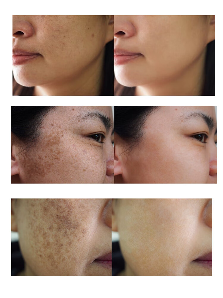 进口氨甲环酸传明酸精华妥塞敏去肝斑晒斑全身镁白