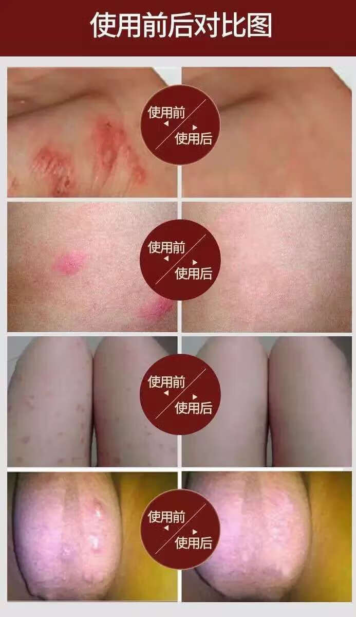 大腿内侧磨破用身体乳可以吗(大腿内侧磨破用身体乳可以吗女生)