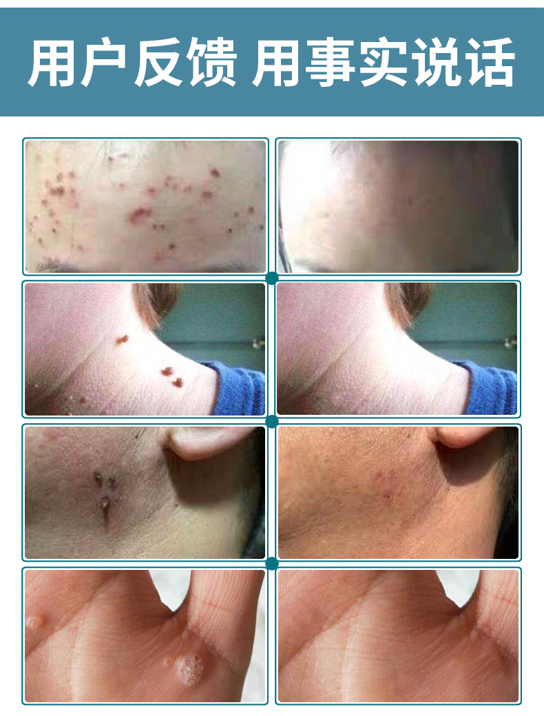 【官方旗舰】疣瘊净克i疣液丝i状i疣立净脖子颈部头部瘊i子去除克优净