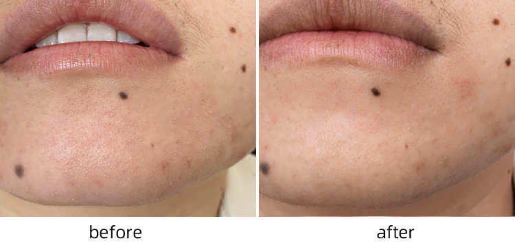 ilso去黑头鼻贴导出液温和收缩毛孔套装男女专用去粉刺闭口黑头贴