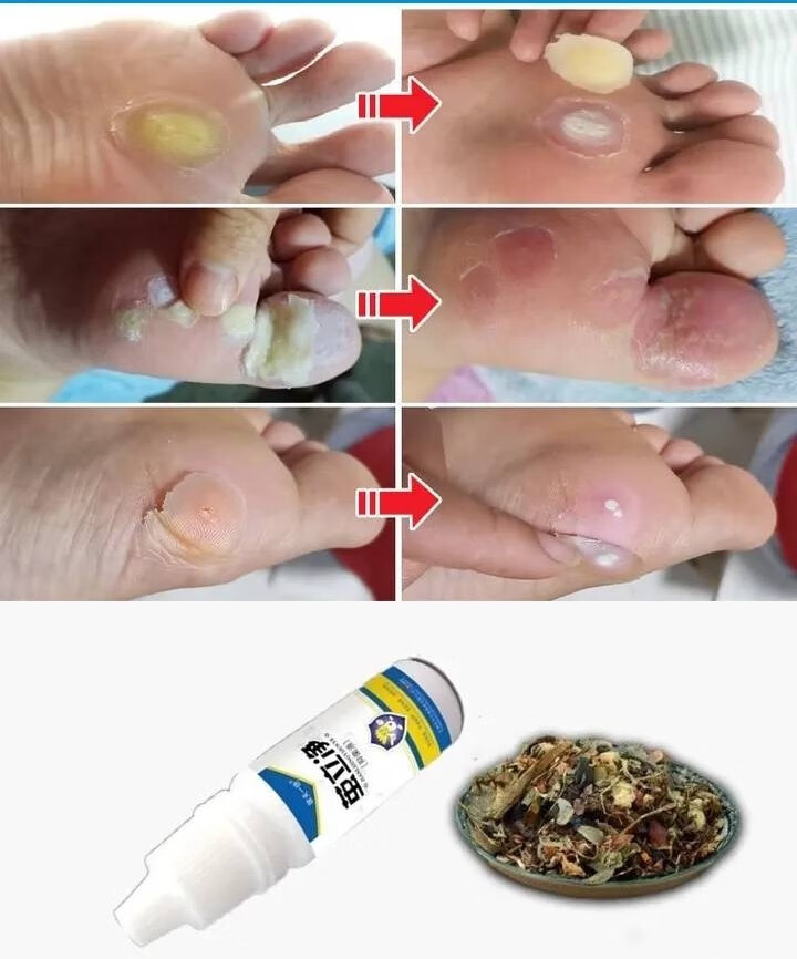 茧立净去老茧子手脚厚茧皮脚底脚垫死皮膏清关节脚趾老茧