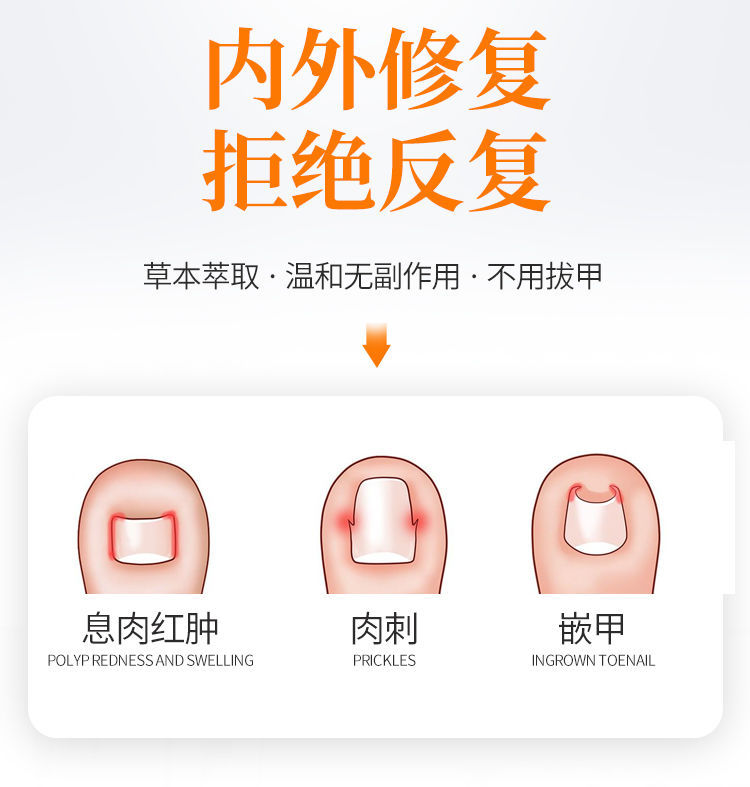 官网浅米草14号康甲宁甲沟炎脓疼痛肉芽红肿纠正十四软膏2瓶套拉拉2盒