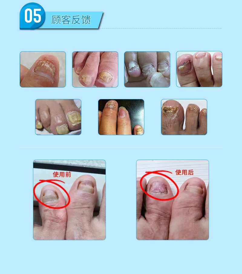 甲院长治脱甲膏去脚趾甲增厚非液中草甲沟炎软化指甲甲院长套装修护液