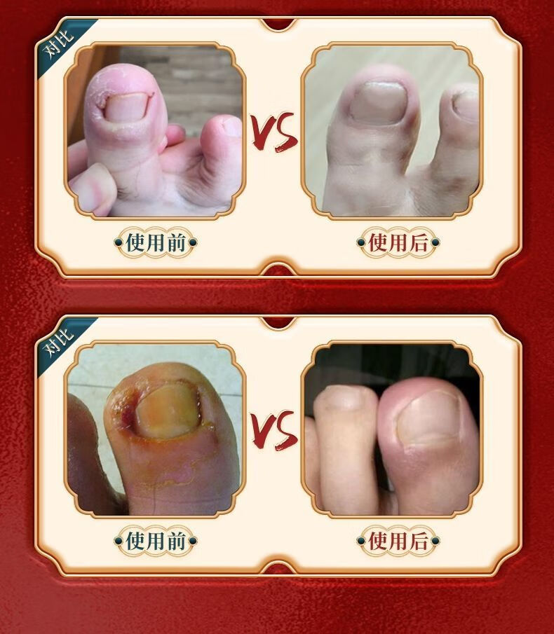 官方旗舰精品浅i米草14号普圣友甲勾二号乳膏软膏2号14号康甲宁甲沟脓